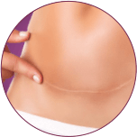 Stretch Mark Reduction cost in indore