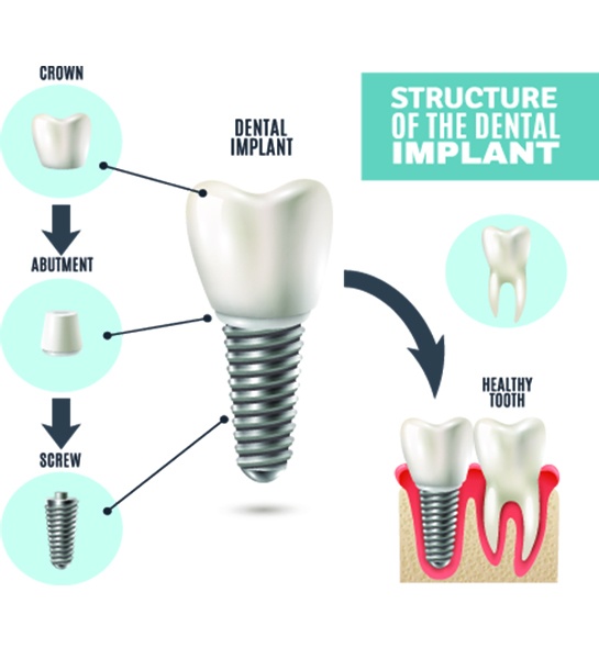 best dental implants in indore