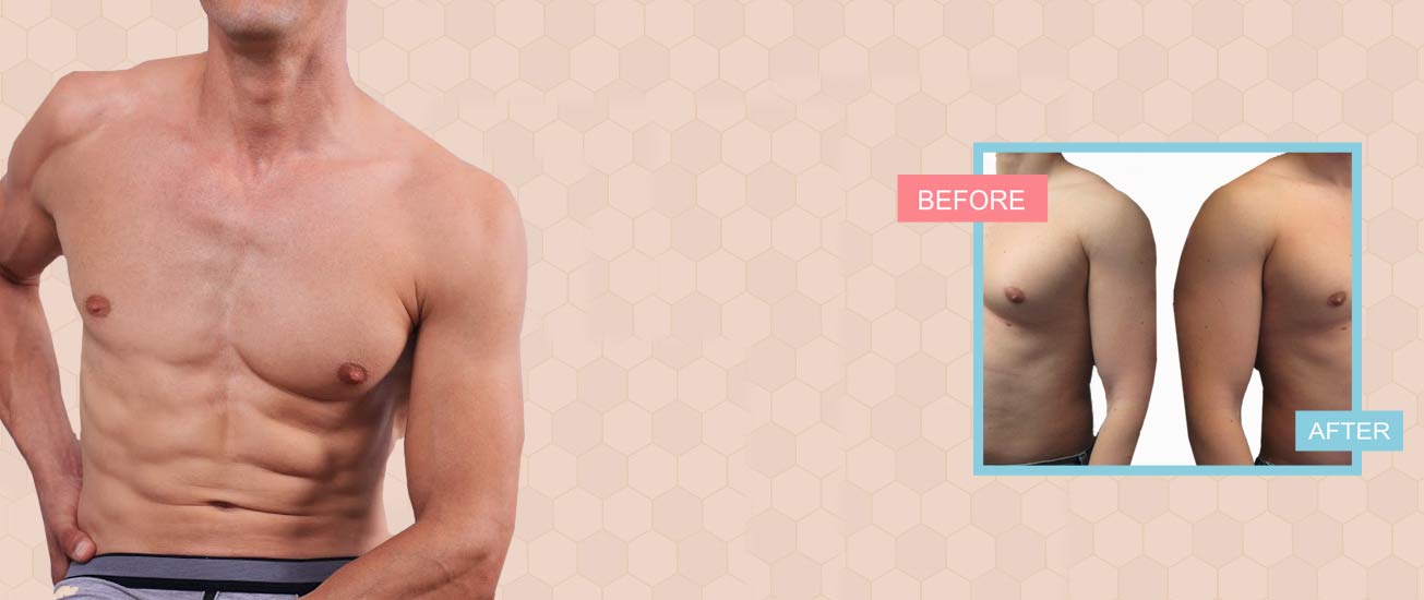 male breast reduction cost in indore