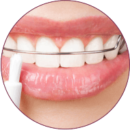 Teeth Alignment in indore