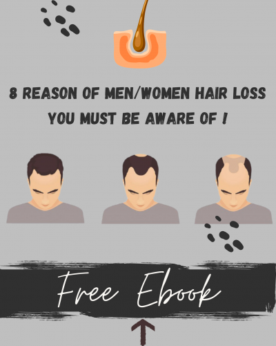 8 Reason Of Men Hair Loss You Must Know Download