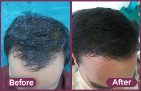 Beard Transplant Before and After