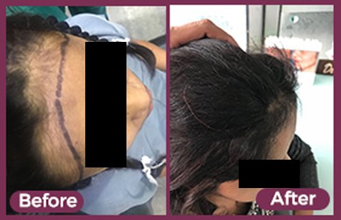 PRP Hair Treatment Before and After