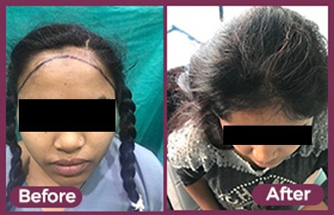 GFC Hair Treatment Before and After