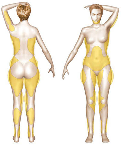 Liposuction