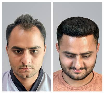 Hair restoration result