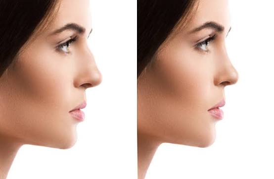 Rhinoplasty Nose Reshaping