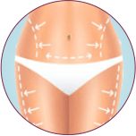 Liposuction in Indore