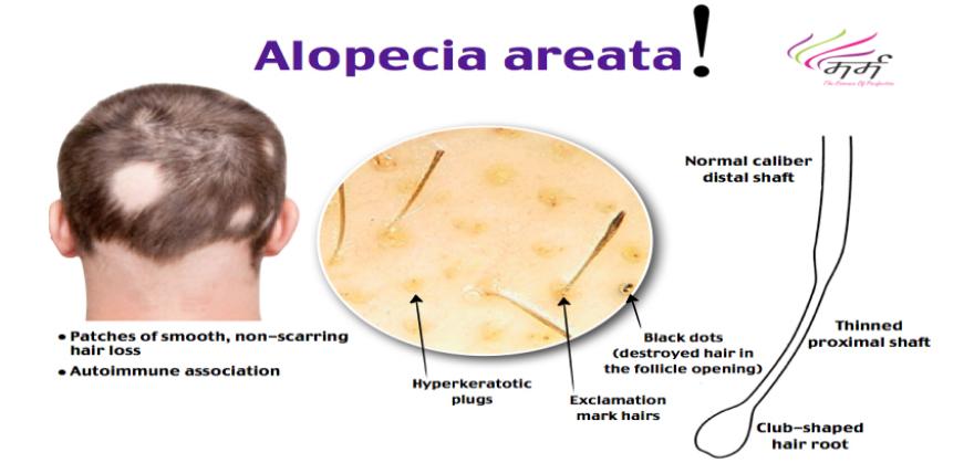 Alopecia- Symptoms, Causes, Treatment, and Diagnosis