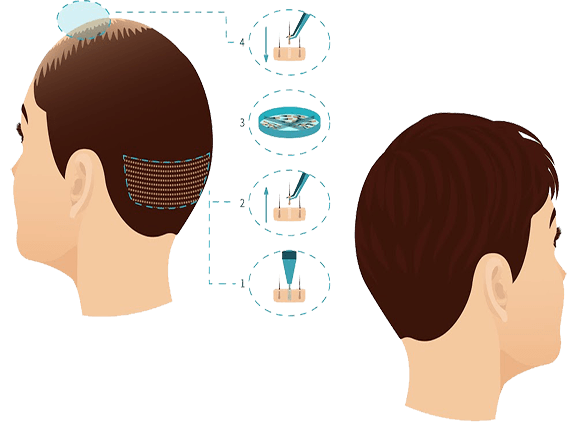 hair Transplant In Indore