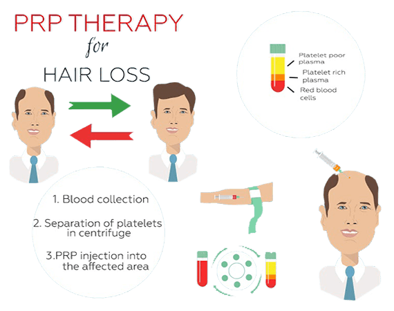 PRP hair loss treatment in indore