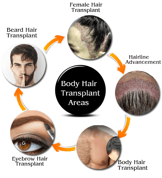 Hair transplant areas 1