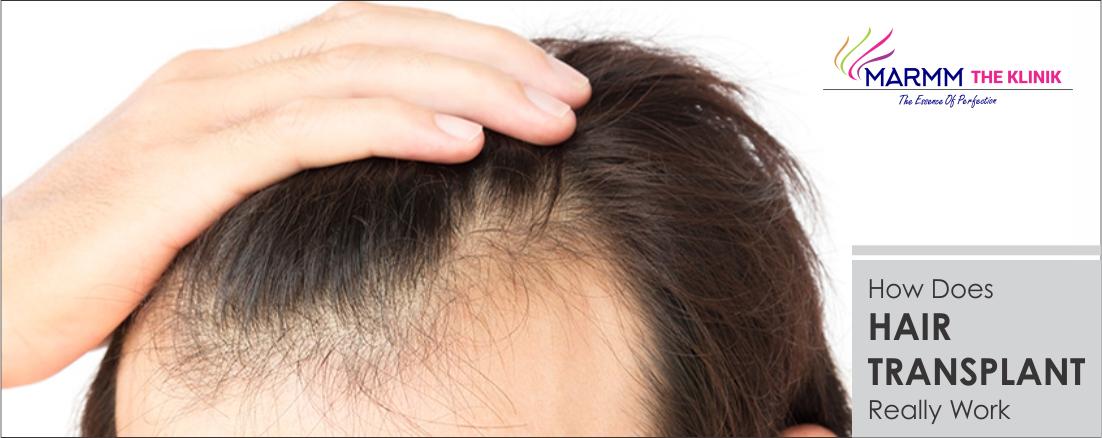 How Does Hair Transplant Really Work and Hair Transplant Cost in Indore