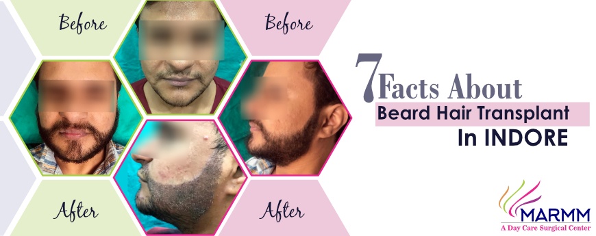 7 Facts About Beard Hair Transplant In Indore